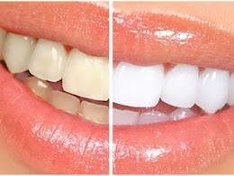 10 Home Remedies for Teeth Whitening