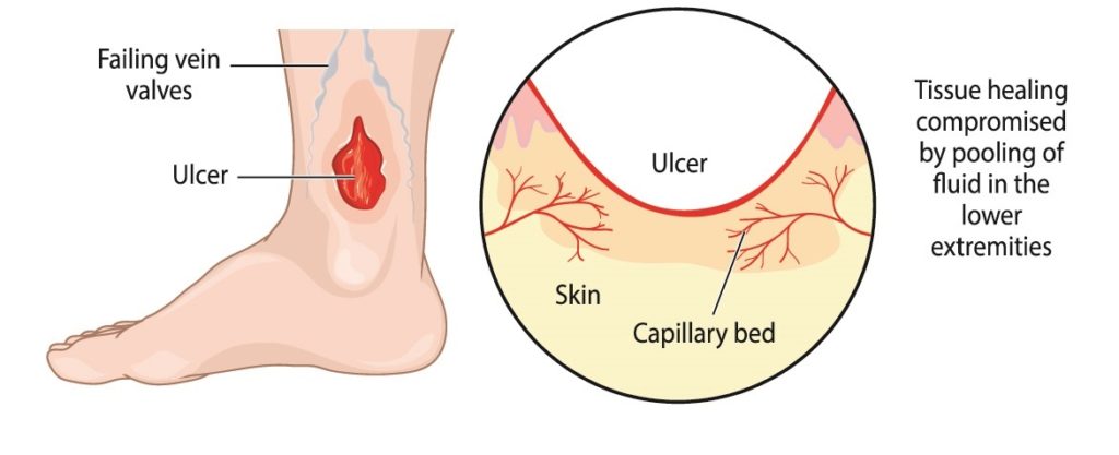 Don’t Ignore That Leg Ulcer: Understanding Venous Ulcers